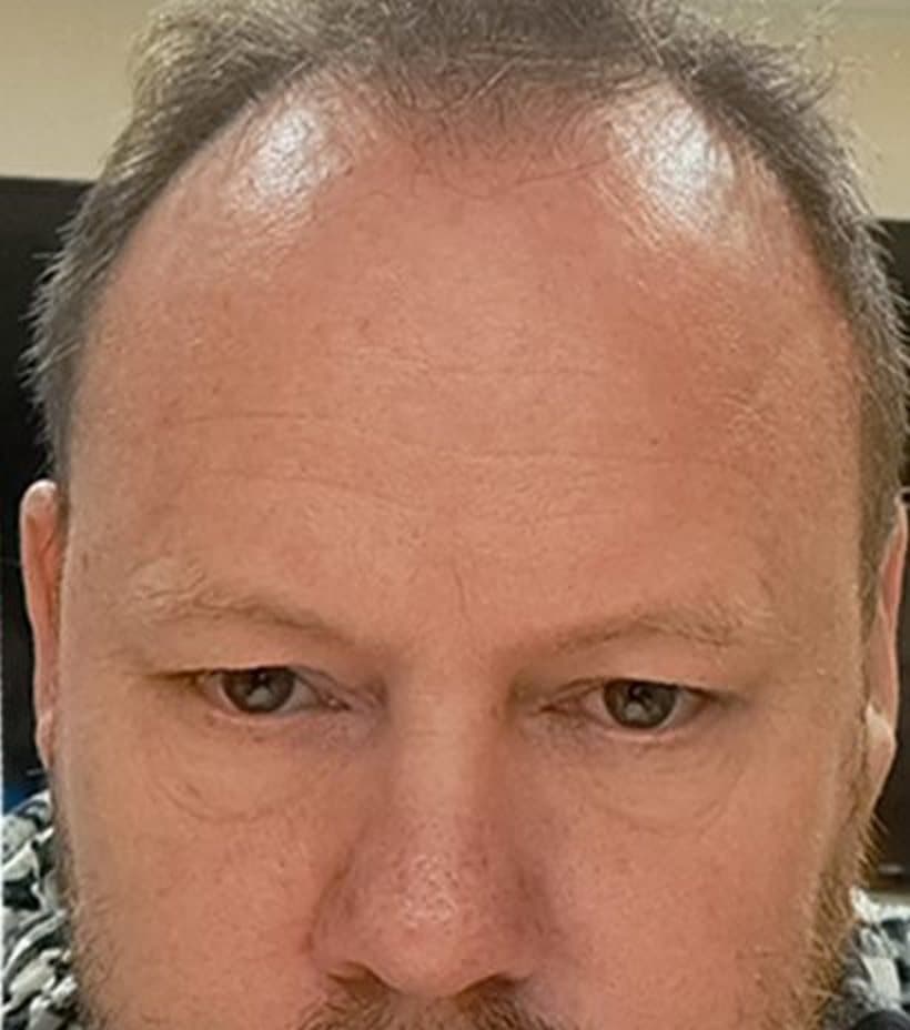 Before a 2,700 graft transplant