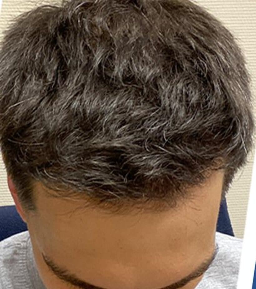After a 5,000 graft transplant