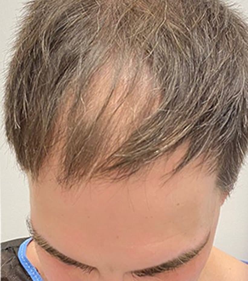 Before a 5,000 graft transplant