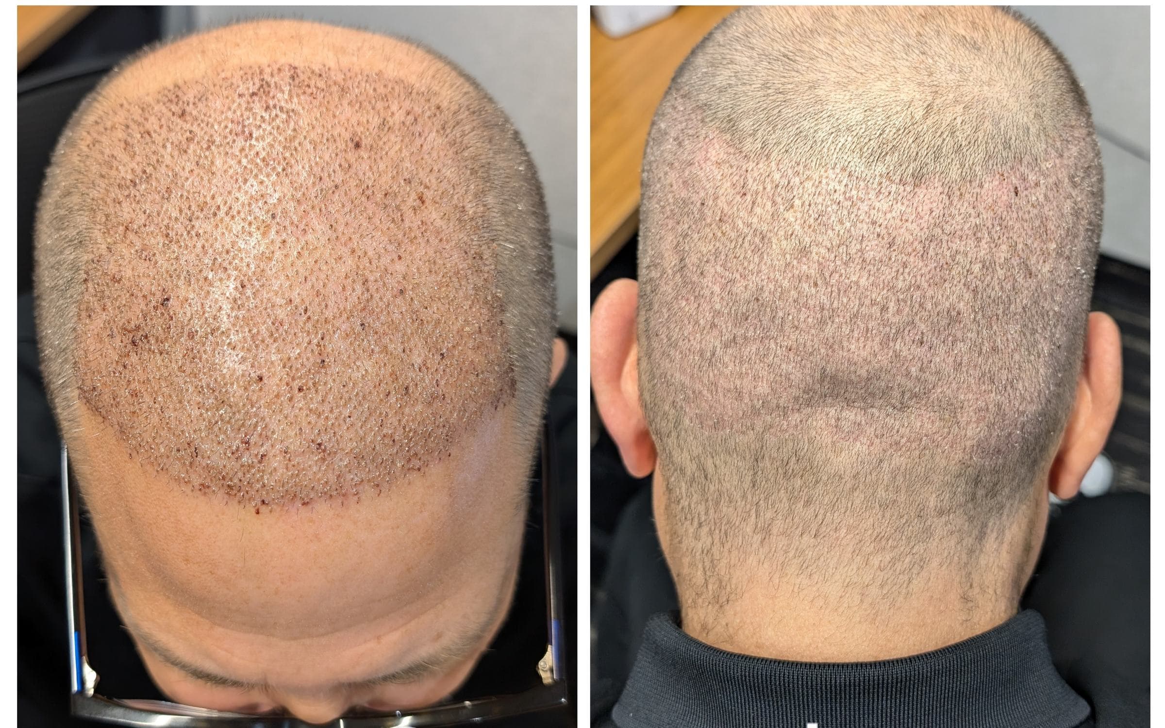The donor area at the back of the head one week after the procedure